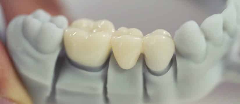 3d printer teeth