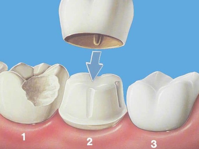 dental crowns