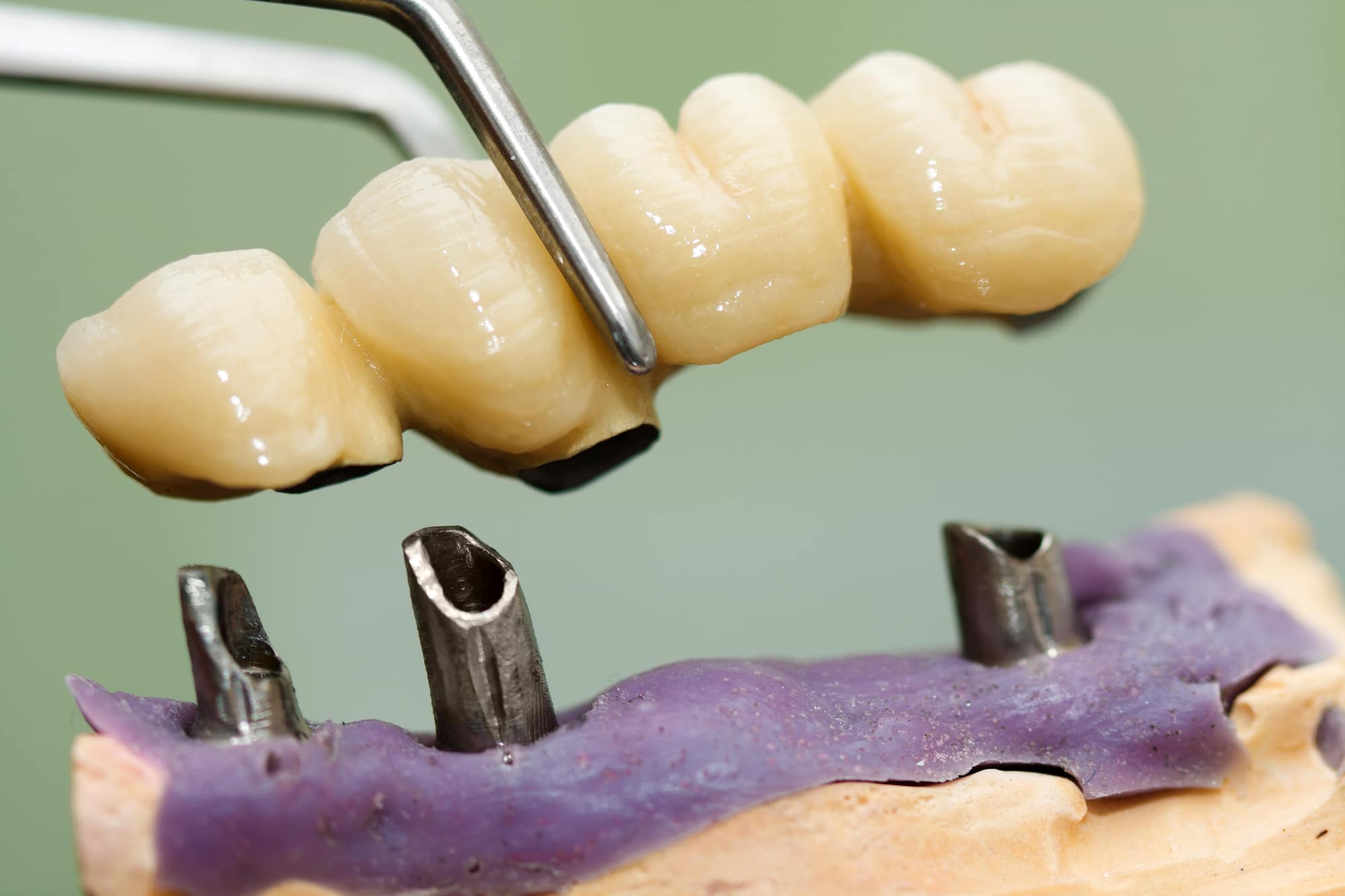 dental implants vs. bridges